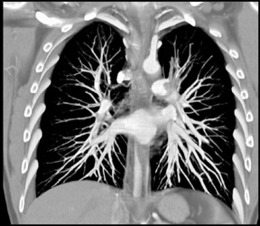 Pulmonary Artery Sarcoma - CTisus CT Scan