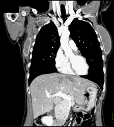 Breast Implant and Axillary Nodes - CTisus CT Scan