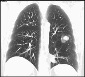 Mass in Zone of Emphysematous Lung - CTisus CT Scan