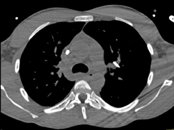 Broken Catheter in Left Pulmonary Artery - CTisus CT Scan