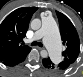 Pulmonic Stenosis - Chest Case Studies - CTisus CT Scanning