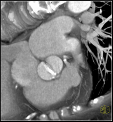 Bicuspid Aortic Valve With Calcification - CTisus CT Scan