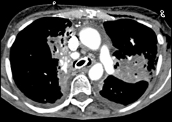 Tumor Infiltration - CTisus CT Scan