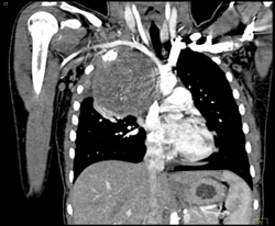 Ewing Sarcoma - CTisus CT Scan