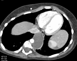 Duplication Cyst - CTisus CT Scan