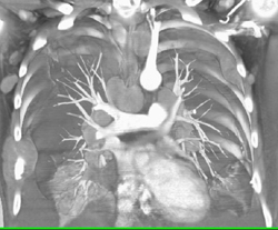 Pleural and Mediastinal Implants - CTisus CT Scan