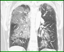 Pulmonary Hemorrhage - CTisus CT Scan