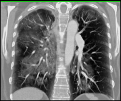 Pulmonary Hemorrhage - CTisus CT Scan