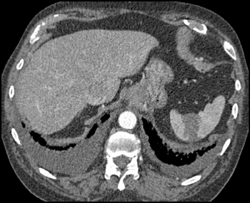 Pulmonary Hemorrhage - CTisus CT Scan