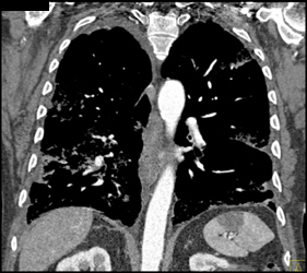 Pulmonary Hemorrhage - CTisus CT Scan