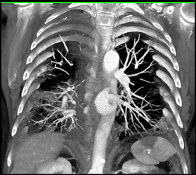 Pulmonary Infarcts and Splenic Infarcts - CTisus CT Scan