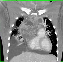 Lymphoma - CTisus CT Scan