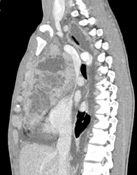 Lymphoma - CTisus CT Scan