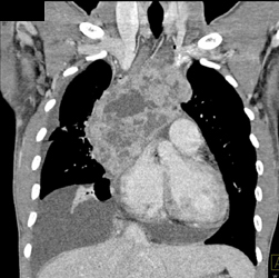 Lymphoma - CTisus CT Scan