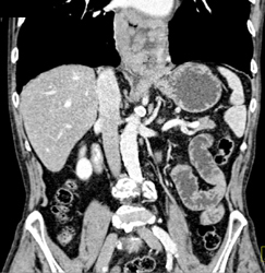 Gastric Cancer in A Hiatal Hernia - CTisus CT Scan