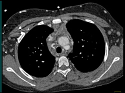 SVC Occlusion With Collaterals - CTisus CT Scan