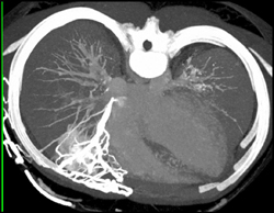 SVC Occlusion With Collaterals - CTisus CT Scan