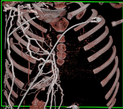 SVC Occlusion With Collaterals - CTisus CT Scan