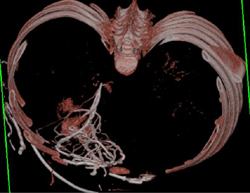 SVC Occlusion With Collaterals - CTisus CT Scan