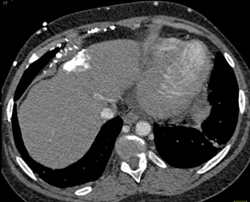 Hot Spot in Liver 20 Degrees to SVC Occlusion - CTisus CT Scan