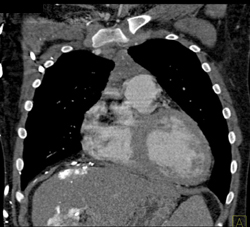 SVC Occlusion With Collaterals - CTisus CT Scan