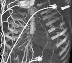 SVC Occlusion With Collaterals - CTisus CT Scan