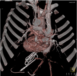 Patent Stent in Pulmonary Artery - CTisus CT Scan