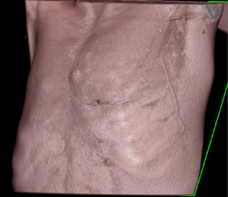 Suture Presses on Skin - CTisus CT Scan