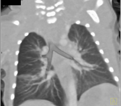 Sequestration - CTisus CT Scan