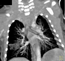 Sequestration - CTisus CT Scan