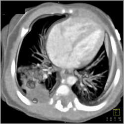 Sequestration - CTisus CT Scan