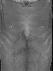 Pectus Deformity - CTisus CT Scan