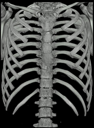 Pectus Deformity - CTisus CT Scan