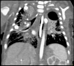 Infiltration of the Lung and Airway Encasement - CTisus CT Scan