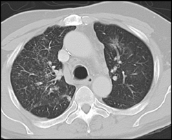 Fungal Pneumonia - CTisus CT Scan