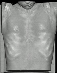 Pectus Deformity - CTisus CT Scan