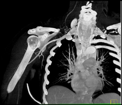 Tracheal Narrowing - CTisus CT Scan