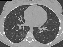 Pulmonary Hemorrhage - CTisus CT Scan