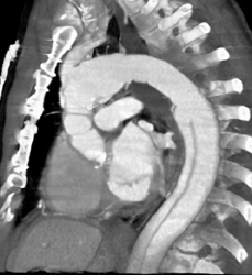 Aortic Dissection - CTisus CT Scan