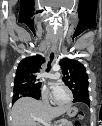 Tumor Encases the Trachea - CTisus CT Scan