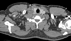 Tracheal Carcinoma - CTisus CT Scan