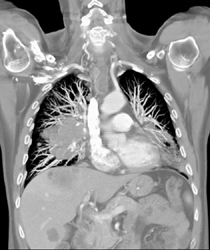 Right Lower Lung Mass - CTisus CT Scan