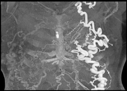 SVC Occlusion With Collaterals - CTisus CT Scan