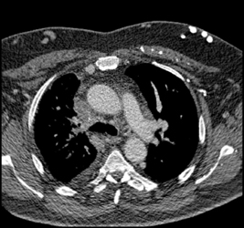 SVC Occlusion With Collaterals - CTisus CT Scan