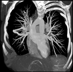 Pulmonary Varix - CTisus CT Scan