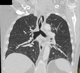 Tracheal Stenosis - CTisus CT Scan