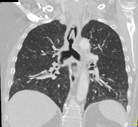 Tracheal Stenosis - CTisus CT Scan