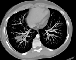 Mucoid Impaction Right Lower Lobe - CTisus CT Scan