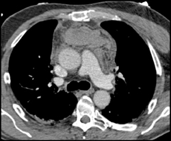 Hemopericardium S/P Trauma - CTisus CT Scan