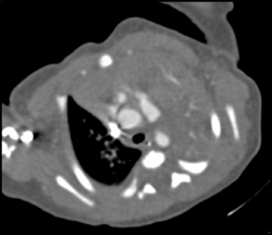 Collapsed LUL - CTisus CT Scan